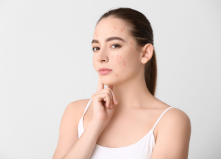 Acne breakouts on the face