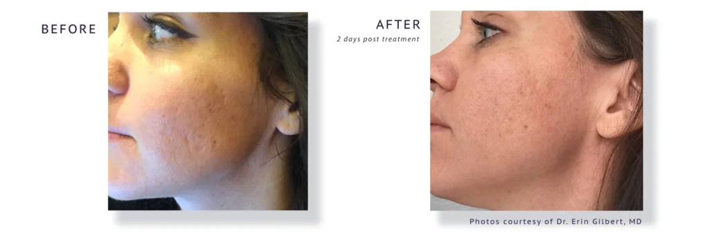 AquaGold facial