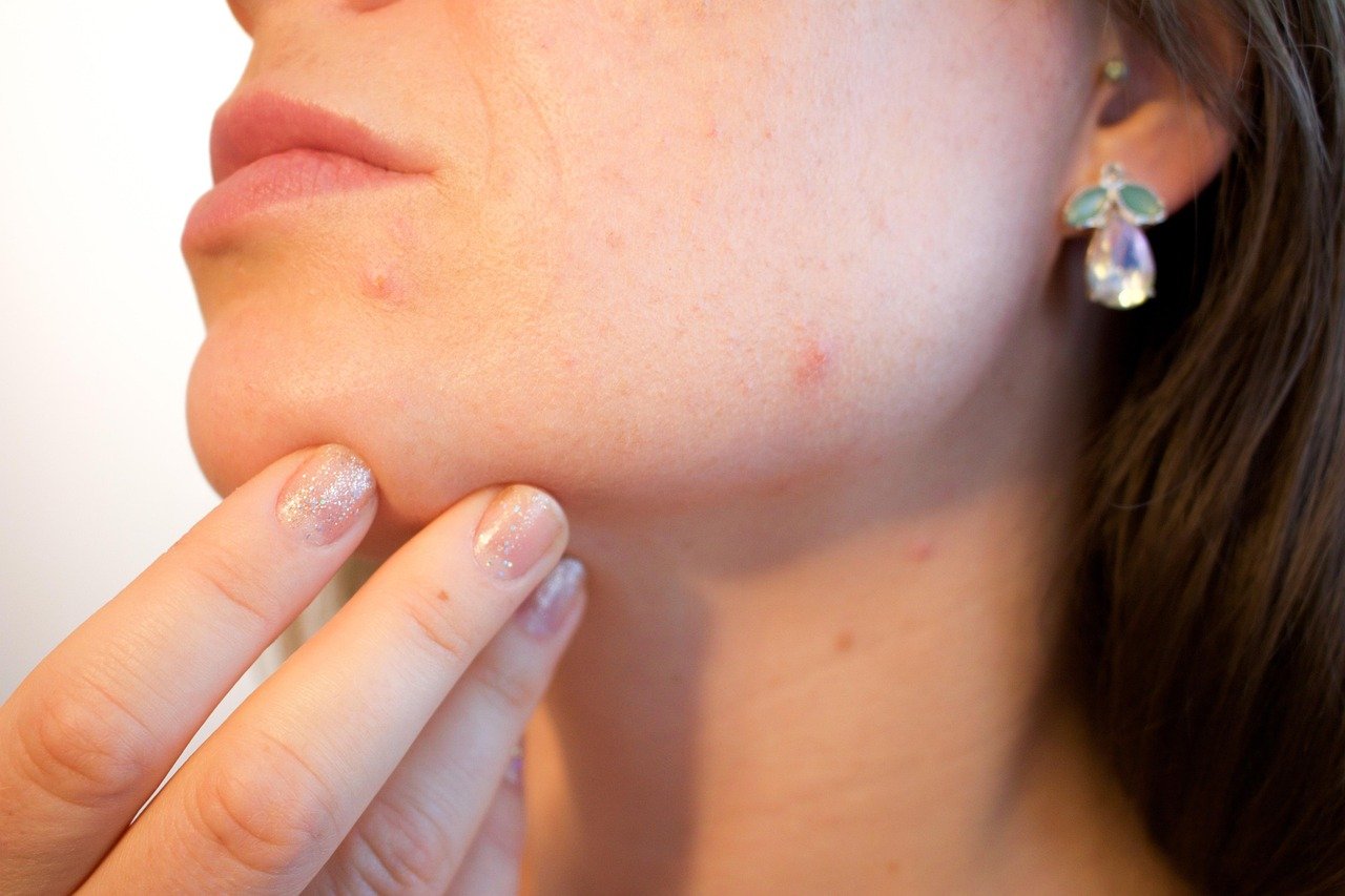 Acne Breakouts on the face