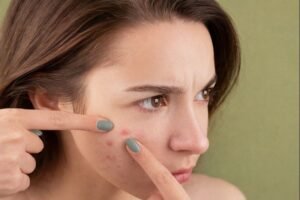 acne marks