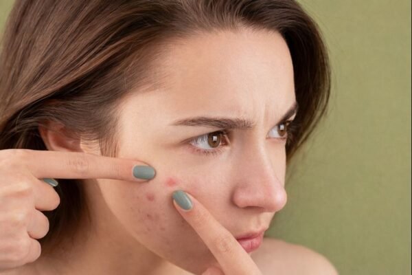 acne marks removal